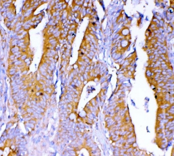 IHC staining of FFPE human colon cancer tissue with DYNLT1 antibody. HIER: boil tissue sections in pH8 EDTA for 20 min and allow to cool before testing.