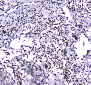 IHC testing of FFPE human breast cancer tissue with GFI1 antibody at 1ug/ml. Required HIER: steam section in pH6 citrate buffer for 20 min and allow to cool prior to staining.
