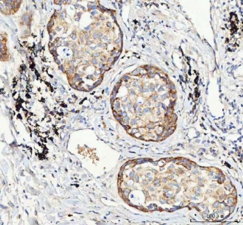 IHC testing of FFPE human lung cancer tissue with M6PR antibody. Required HIER: steam section in pH8 EDTA buffer for 20 min and allow to cool prior to staining.