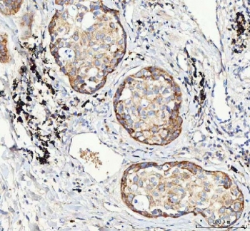 IHC testing of FFPE human lung cancer tissue with M6PR antibody. Required HIER: steam section in pH8 EDTA buffer for 20 min and allow to cool prior to staining.