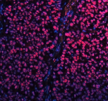 Immunofluorescent staining of FFPE human non-small cell carcinoma tissue with SP1 antibody (red) and DAPI nuclear stain (blue). HIER: steam section in pH8 EDTA buffer for 20 min..