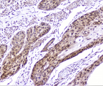 IHC staining of FFPE human esophagus squama cancer with SP1 antibody at 1ug/ml. HIER: boil tissue sections in pH6, 10mM citrate buffer, for 10-20 min followed by cooling at RT for 20 min.