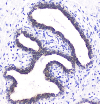 IHC staining of FFPE human breast cancer with BTC antibody at 1ug/ml. HIER: boil tissue sections in pH6, 10mM citrate buffer, for 10-20 min followed by cooling at RT for 20 min.