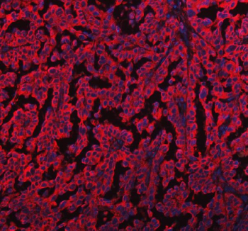 Immunofluorescent staining of FFPE human ovarian cancer tissue with EML4 antibody (red) and DAPI nuclear stain (blue). HIER: steam section in pH8 EDTA buffer for 20 min.