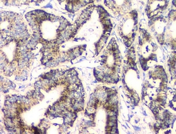 IHC staining of FFPE human intestinal cancer with FH antibody. HIER: boil tissue sections in pH8 EDTA for 20 min and allow to cool before testing.