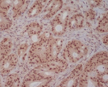 IHC staining of FFPE human colon cancer with PIK3R2 antibody. HIER: boil tissue sections in pH6, 10mM citrate buffer, for 10-20 min and allow to cool before testing.