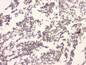 IHC staining of FFPE human glioma with APP antibody at 1ug/ml. HIER: boil tissue sections in pH6, 10mM citrate buffer, for 10-20 min and allow to cool before testing.