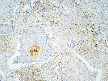 IHC staining of FFPE human lung cancer with Annexin A3 antibody at 1ug/ml. HIER: boil tissue sections in pH6, 10mM citrate buffer, for 10-20 min and allow to cool before testing.