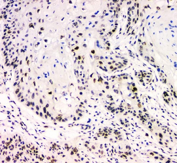 IHC staining of FFPE human esophagus squama cancer with BCL9L antibody. HIER: boil tissue sections in pH6, 10mM citrate buffer, for 20 min and allow to cool before testing.