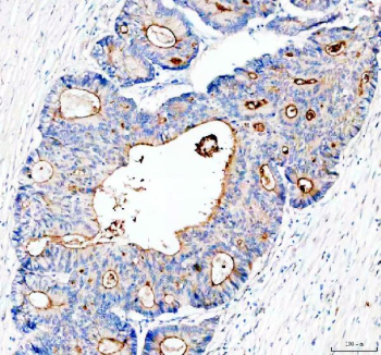 IHC staining of FFPE human colon cancer tissue with MUC13 antibody, HRP-secondary and DAB substrate. HIER: boil tissue sections in pH8 EDTA for 20 min and allow to cool before testing.
