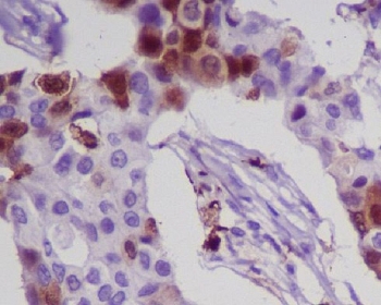 IHC staining of FFPE human breast cancer with S100A8 antibody. HIER: boil tissue sections in pH6, 10mM citrate buffer, for 10-20 min and allow to cool before testing.
