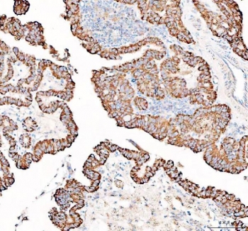 IHC staining of FFPE human thyroid cancer tissue with PPA2 antibody. HIER: boil tissue sections in pH8 EDTA for 20 min and allow to cool before testing.