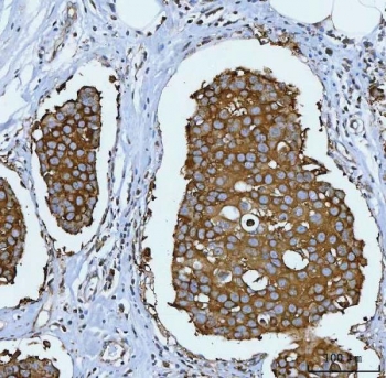 IHC staining of FFPE human breast cancer tissue with HSP90 alpha/beta antibody. HIER: boil tissue sections in pH8 EDTA for 20 min and allow to cool before testing.