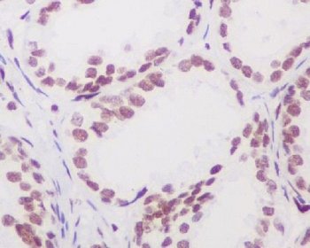 IHC staining of FFPE human prostate tissue with Androgen Receptor antibody. HIER: boil tissue sections in pH6, 10mM citrate buffer, for 10-20 min and allow to cool before testing.