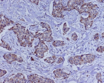 IHC staining of FFPE human breast cancer with BMP4 antibody. HIER: boil tissue sections in pH6, 10mM citrate buffer, for 10-20 min and allow to cool before testing.