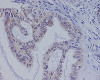 IHC staining of FFPE human ovarian cancer with BRAF antibody. HIER: boil tissue sections in pH6, 10mM citrate buffer, for 10-20 min and allow to cool before testing.