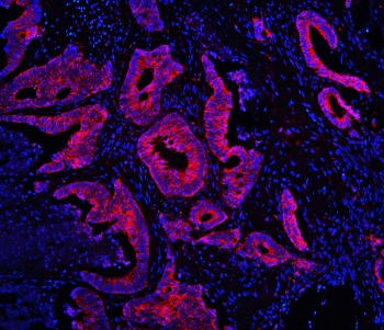 Immunofluorescent staining of FFPE human intestinal cancer with TDRD3 antibody (red) at 1ug/ml and DAPI nuclear stain (blue). HIER: steam section in pH6 citrate buffer for 20 min.