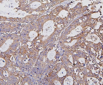 IHC staining of FFPE human rectal cancer with Hexokinase 1 antibody. HIER: boil tissue sections in pH8 EDTA for 20 min and allow to cool before testing.