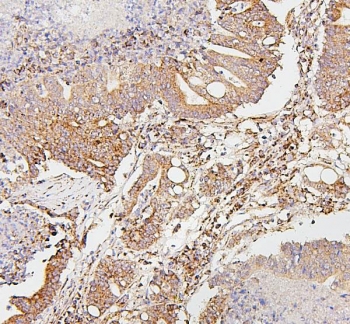 IHC staining of FFPE human intestinal cancer with SDHB antibody. HIER: boil tissue sections in pH6, 10mM citrate buffer, for 20 min and allow to cool before testing.