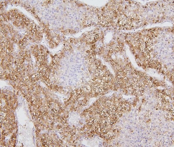 IHC staining of FFPE human liver cancer with CYP2E1 antibody. HIER: boil tissue sections in pH6, 10mM citrate buffer, for 20 min and allow to cool before testing.