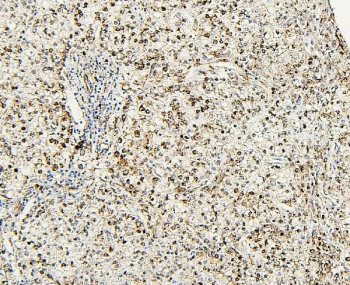 IHC staining of FFPE human liver cancer with PXR/NR1I2 antibody. HIER: boil tissue sections in pH6, 10mM citrate buffer, for 20 min and allow to cool before testing.