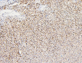IHC staining of FFPE human renal cancer with Polycystin 2 antibody. HIER: boil tissue sections in pH6, 10mM citrate buffer, for 20 min and allow to cool before testing.