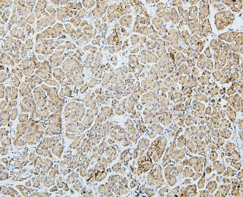 IHC staining of FFPE human pancreatic cancer with MTR antibody. HIER: boil tissue sections in pH6, 10mM citrate buffer, for 20 min and allow to cool before testing.