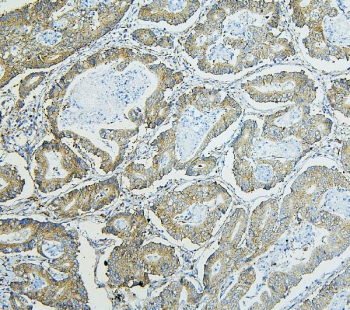 IHC staining of FFPE human rectal cancer with RPL13A antibody. HIER: boil tissue sections in pH6, 10mM citrate buffer, for 20 min and allow to cool before testing.