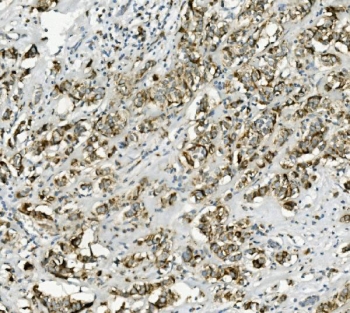 IHC staining of FFPE human breast cancer with PCK2 antibody. HIER: boil tissue sections in pH8 EDTA for 20 min and allow to cool before testing.