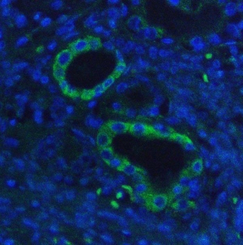 Immunofluorescent staining of FFPE human lung cancer with HK1 antibody (green) and DAPI nuclear stain (blue). HIER: steam section in pH6 citrate buffer for 20 min.
