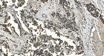 IHC staining of FFPE human bladder cancer with Folliculin antibody. HIER: boil tissue sections in pH8 EDTA for 20 min and allow to cool before testing.