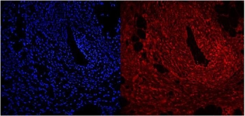Immunofluorescent staining of FFPE human intestinal cancer with NFIC antibody (red) and DAPI nuclear stain (blue). HIER: steam section in pH6 citrate buffer for 20 min.