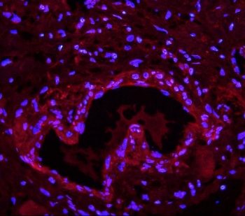 Immunofluorescent staining of FFPE human breast cancer with LIN28A antibody (red) and DAPI nuclear stain (blue). HIER: steam section in pH6 citrate buffer for 20 min.