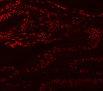 Immunofluorescent staining of FFPE human colon cancer with Muscleblind-like 1 antibody. HIER: steam section in pH6 citrate buffer for 20 min.