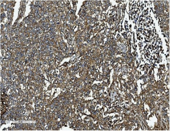 IHC staining of FFPE human lung cancer with CLTC antibody. HIER: boil tissue sections in pH8 EDTA for 20 min and allow to cool before testing.