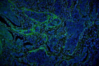 Immunofluorescent staining of FFPE human breast cancer tissue with Vinculin antibody (green) and DAPI nuclear stain (blue). HIER: steam section in pH6 citrate buffer for 20 min.