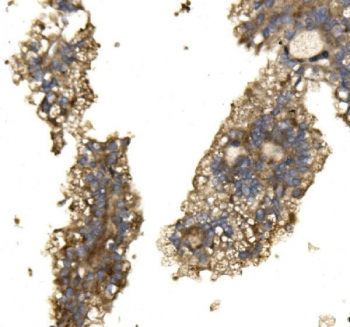 IHC staining of FFPE human renal cancer with Arginase 2 antibody. HIER: boil tissue sections in pH8 EDTA for 20 min and allow to cool before testing.