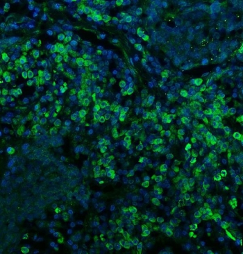 Immunofluorescent staining of FFPE human lung cancer with CD74 antibody (green) and DAPI nuclear stain (blue). HIER: steam section in pH8 EDTA for 20 min.