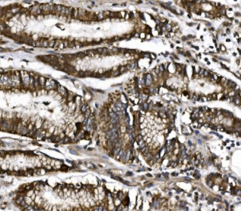 IHC staining of FFPE human gastric cancer with MitoNEET antibody. HIER: boil tissue sections in pH8 EDTA for 20 min and allow to cool before testing.