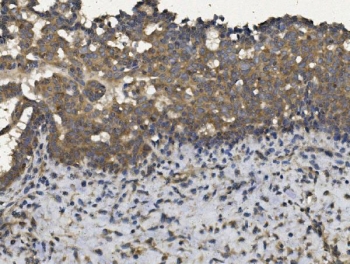 IHC staining of FFPE human breast cancer with EIF2AK4 antibody. HIER: boil tissue sections in pH8 EDTA for 20 min and allow to cool before testing.