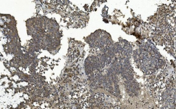 IHC staining of FFPE human lung cancer with MAPK7 antibody. HIER: boil tissue sections in pH8 EDTA for 20 min and allow to cool before testing.