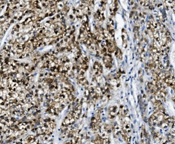 IHC staining of FFPE human liver cancer with Paraoxonase 1 antibody. HIER: boil tissue sections in pH8 EDTA for 20 min and allow to cool before testing.