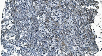 IHC staining of FFPE human liver cancer with MCU antibody. HIER: boil tissue sections in pH8 EDTA for 20 min and allow to cool before testing.