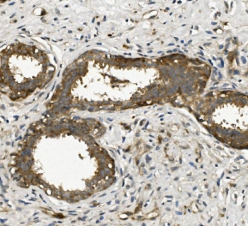 IHC staining of FFPE human breast cancer with ACTR2 antibody. HIER: boil tissue sections in pH8 EDTA for 20 min and allow to cool before testing.