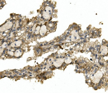 IHC staining of FFPE human renal cancer with ALAS1 antibody. HIER: boil tissue sections in pH8 EDTA for 20 min and allow to cool before testing.