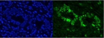 Immunofluorescent staining of FFPE human rectal cancer with CBX8 antibody. HIER: boil tissue sections in pH8 EDTA for 20 min and allow to cool before testing.