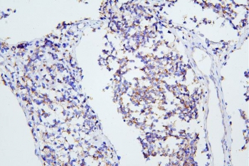 IHC staining of FFPE human glioma with mGluR1 antibody. HIER: boil tissue sections in pH8 EDTA for 20 min and allow to cool before testing.