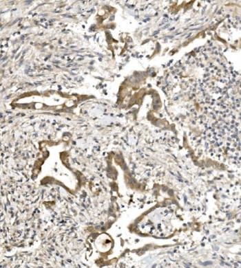 IHC staining of FFPE human rectal cancer with Nectin 1 antibody. HIER: boil tissue sections in pH8 EDTA for 20 min and allow to cool before testing.