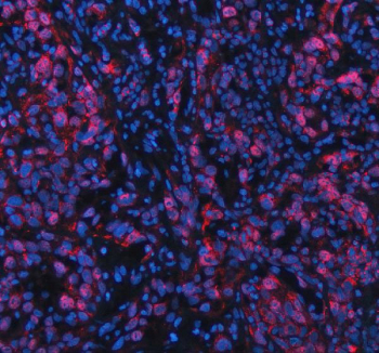 Immunofluorescent staining of FFPE human bladder cancer tissue with NFAT5 antibody (red) and DAPI nuclear stain (blue). HIER: steam section in pH8 EDTA buffer for 20 min.