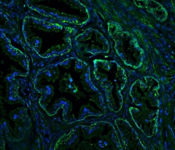 Immunofluorescent staining of FFPE human prostate cancer with Nogo A antibody (green) and DAPI nuclear stain (blue). HIER: steam section in pH8 EDTA for 20 min.